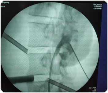 Laparoscopy Assisted PCNL (PercutaneousNephrolithotomy)