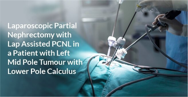 Laparoscopic Partial Nephrectomy with Lap Assisted PCNL in A Patient with Left Mid Pole Tumour with Lower Pole Calculus