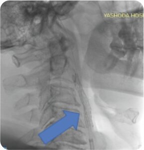 Symptomatic Carotid Near Total Occlusion Treated by Carotid Stenting