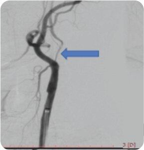 Symptomatic Carotid Near Total Occlusion Treated by Carotid Stenting
