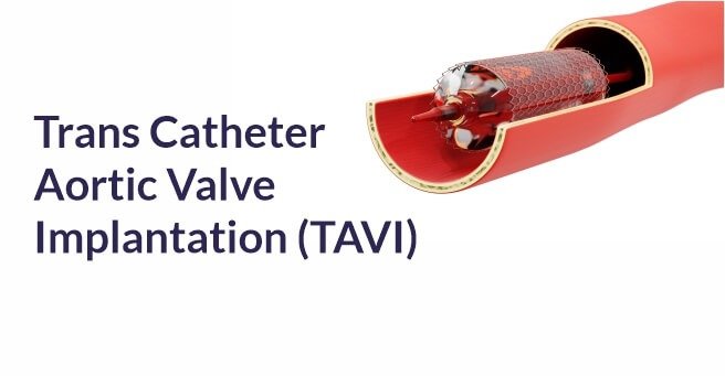 Trans Catheter Aortic Valve Implantation (TAVI) – Case-1
