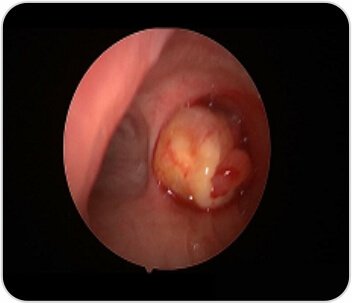 Tumor Removal by Bronchoscopy Case-1b