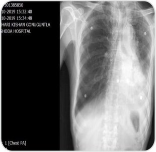 Tumor Removal by Bronchoscopy Case-2b
