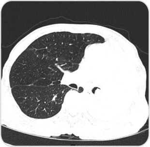 Tumor Removal by Bronchoscopy Case-2e