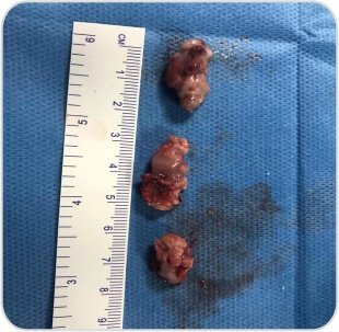 Tumor Removal by Bronchoscopy Case-2f