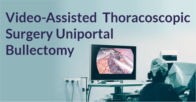 Video-Assisted Thoracoscopic Surgery Uniportal Bullectomy