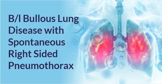B/l Bullous Lung Disease with Spontaneous Right Sided Pneumothorax
