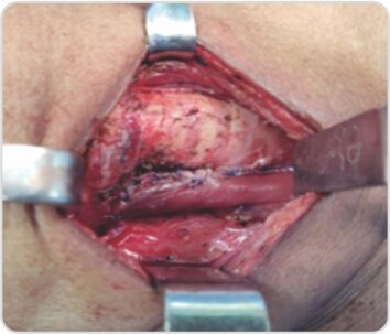 Papillary Carcinoma of Thyroid