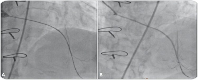 Percutaneous Coronary Intervention of A Diffusely Degenerated Saphenous Vein Graft