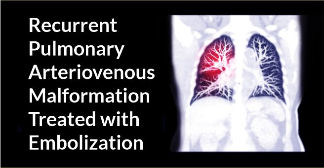 Recurrent Pulmonary Arteriovenous Malformation Treated with Embolization