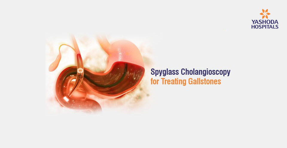 Spyglass Cholangioscopy