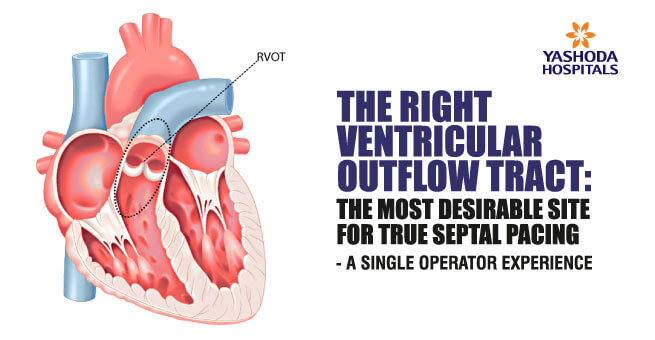The Right Ventricular outflow tract : the most desirable site for true septal spacing – A single operator experience