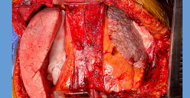 Pulmonary Alveolar Microlithiasis operative finding