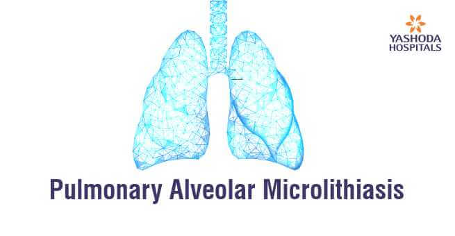 Pulmonary Alveolar Microlithiasis (PAM)