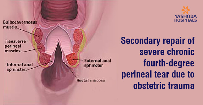 Secondary repair of severe chronic fourth-degree perineal tear due to obstetric trauma