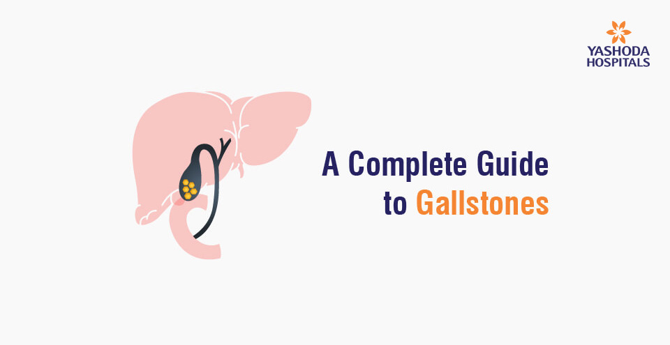 A Complete Guide to Gallstones