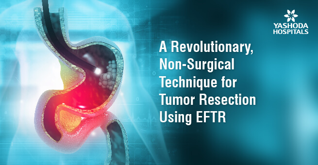 A Revolutionary, Non-Surgical Technique for Tumor Resection Using EFTR