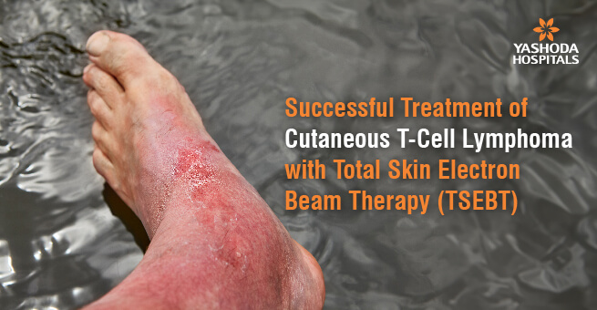 Successful Treatment of Cutaneous T-Cell Lymphoma with Total Skin Electron Beam Therapy (TSEBT)