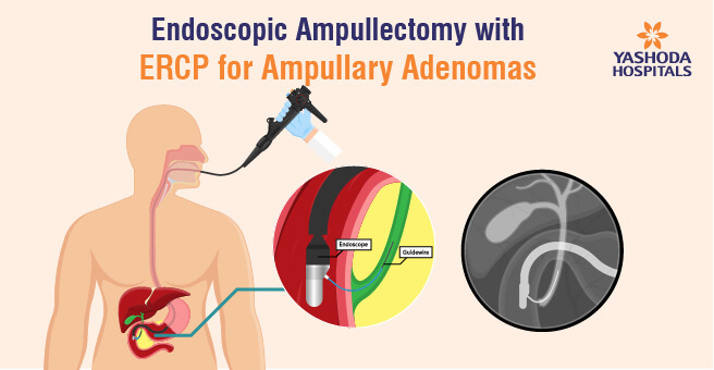 Endoscopic Ampullectomy with ERCP for Ampullary Adenomas