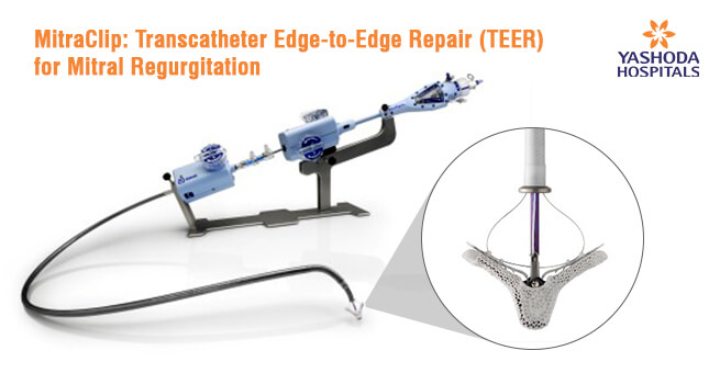 MitraClip: Transcatheter Edge-to-Edge Repair (TEER) for Mitral Regurgitation