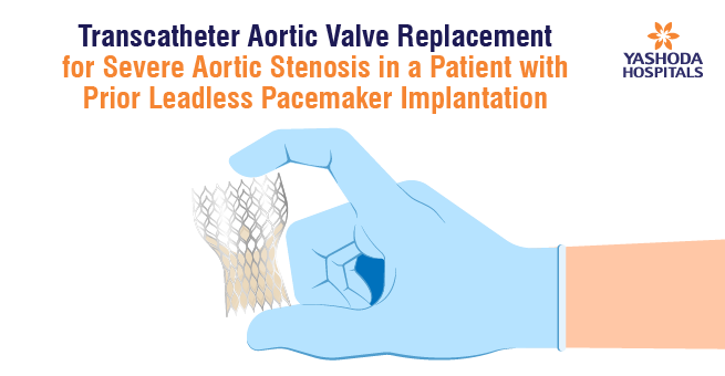 TAVR for Severe Aortic Stenosis in a Patient with Prior Leadless Pacemaker Implantation