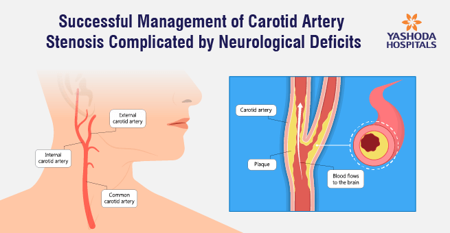 Successful Management of Carotid Artery Stenosis Complicated by Neurological Deficits