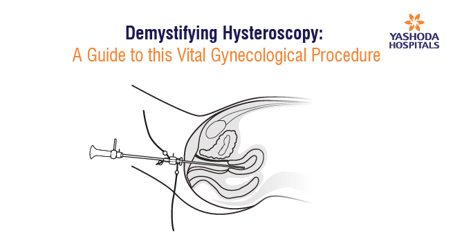 Demystifying Hysteroscopy: A Guide to this Vital Gynecological Procedure