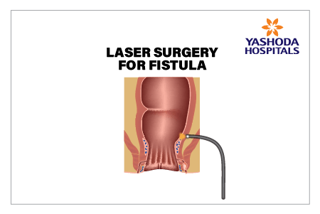 anal fistulas treated