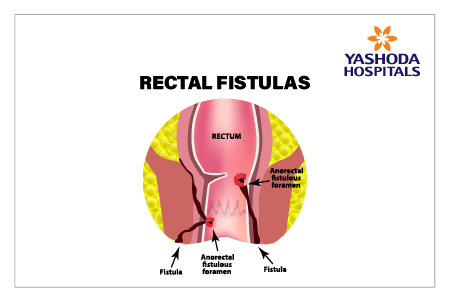 What is an anal fistula