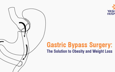 Gastric Bypass Surgery: The Solution to Obesity and Weight Loss