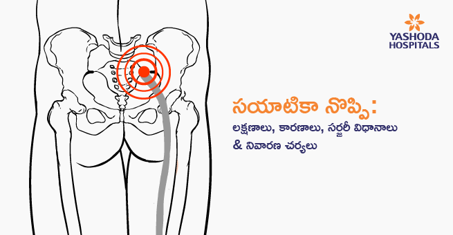 Sciatica Pain Symptoms Causes Main Banner