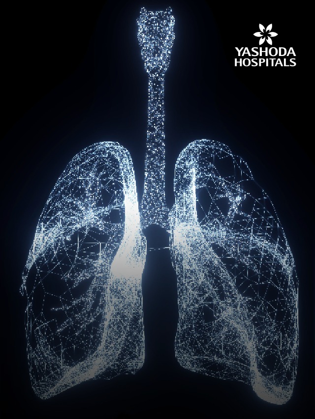 lung cancer slide 2