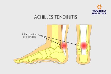 symptoms of Achilles Tendinitis