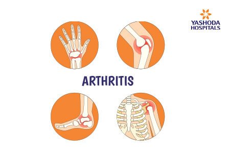 Arthritis