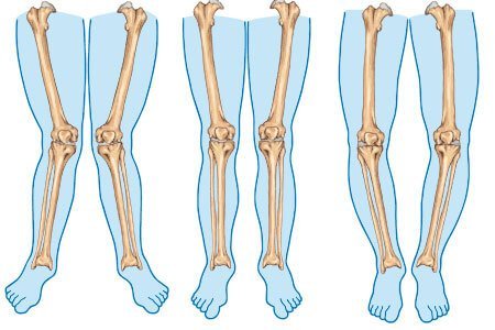 symptoms of Bowed Legs