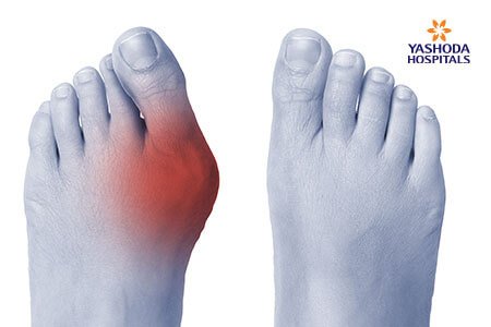  risk factors of Bunions