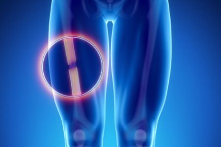 symptoms of Burning Thigh Pain