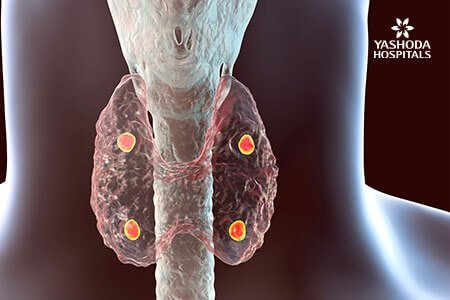 Calcium metabolism disorders