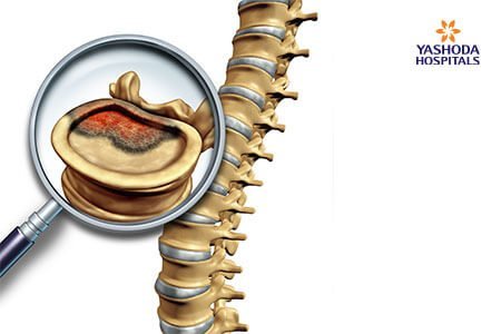 Chordoma-Causes