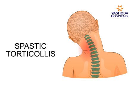 Congenital Muscular-Torticollis causes