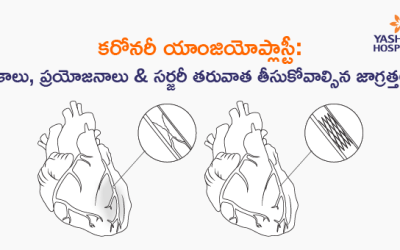 కరోనరీ యాంజియోప్లాస్టీ: రకాలు, ప్రయోజనాలు & సర్జరీ తరువాత తీసుకోవాల్సిన జాగ్రత్తలు