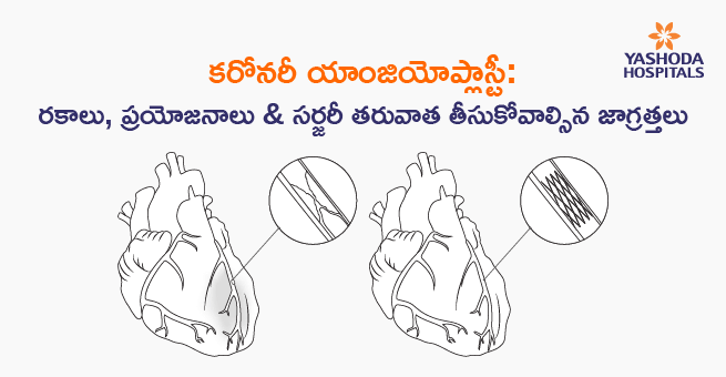 Coronary Angioplasty Types, Benefits & Precautions After Surgery telugu banner