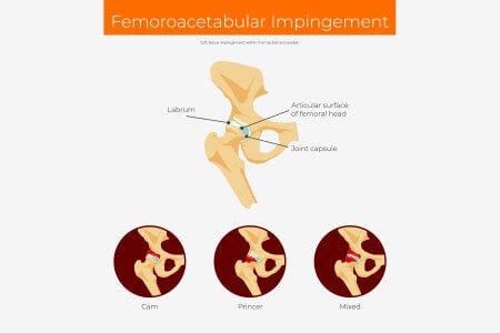 Femoroacetabular Impingement