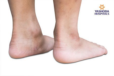 Flexible Flatfoot in Children