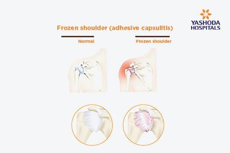 Frozen Shoulder