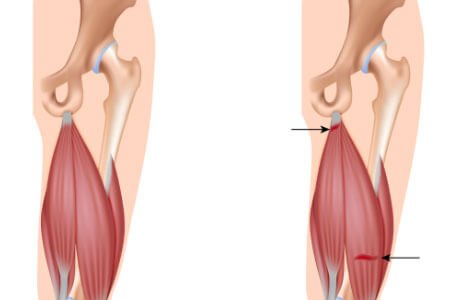 Hamstring Muscle Strain