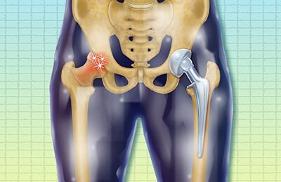 Hip replacement surgery for diseases and injuries of hip  class=