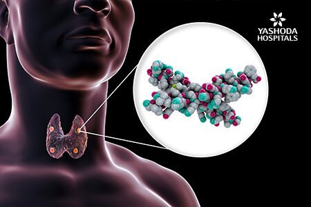 symptoms of Hyperparathyroidism