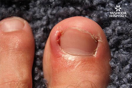 symptoms of Ingrown Toenail