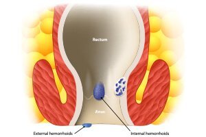 hemorrhoids or piles